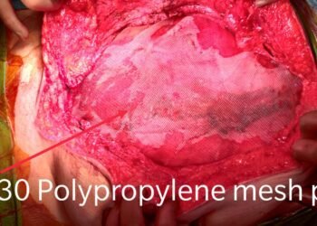 An 80yr old man successfully undergoes TAR procedure for Hernia