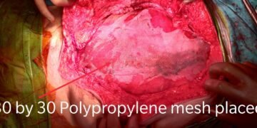 An 80yr old man successfully undergoes TAR procedure for Hernia