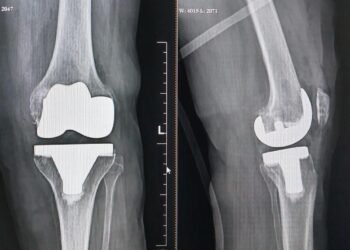 78yr old woman suffering from ‘neglected club foot’ successfully went knee replacement surgery