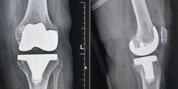 78yr old woman suffering from ‘neglected club foot’ successfully went knee replacement surgery