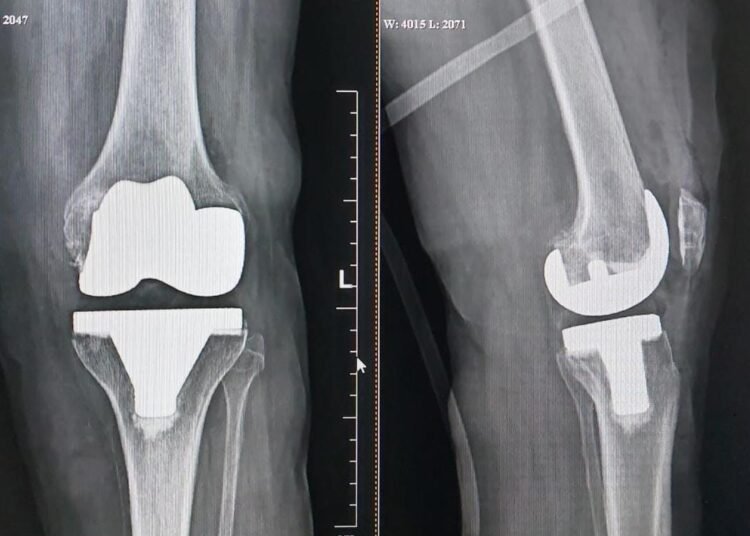 78yr old woman suffering from ‘neglected club foot’ successfully went knee replacement surgery 