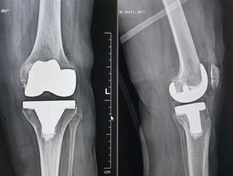 78yr old woman suffering from ‘neglected club foot’ successfully went knee replacement surgery 