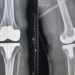 78yr old woman suffering from ‘neglected club foot’ successfully went knee replacement surgery 