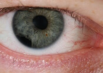 21-yr old Yemeni woman with TB in eyes successfully treated