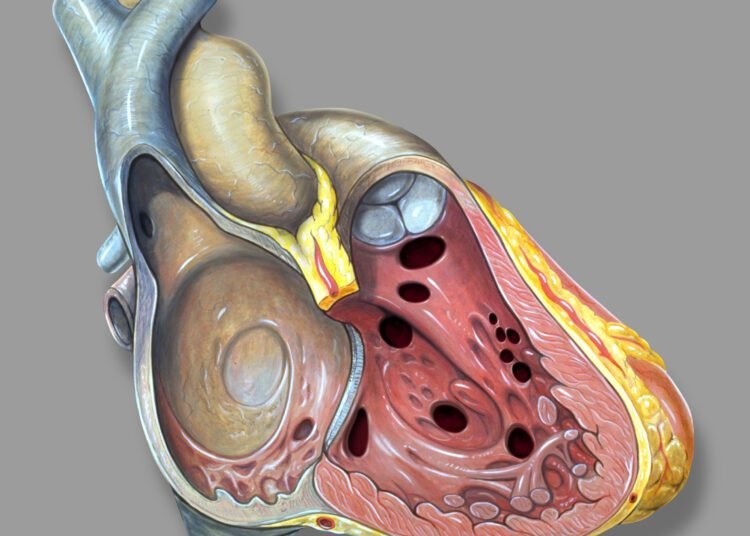 72yr-old man with life threatening rare variant of heart valve disease successfully treated