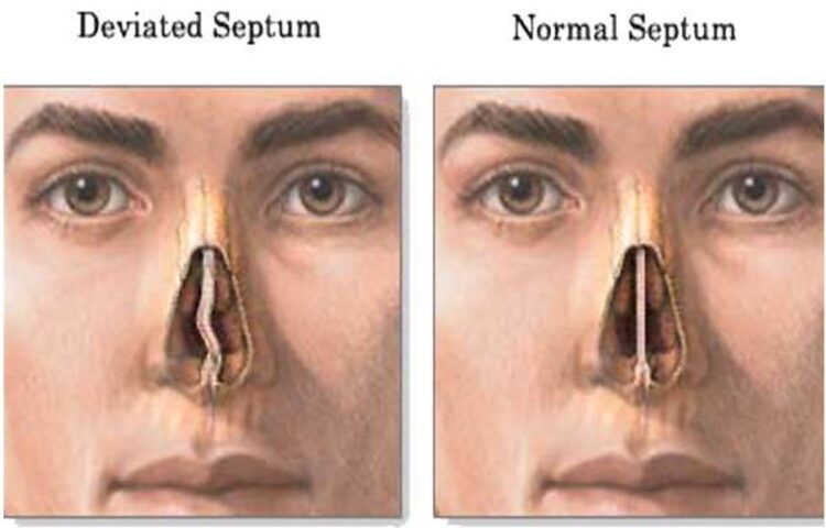 10yr old boy successfully undergoes Deviated Septum correction surgery