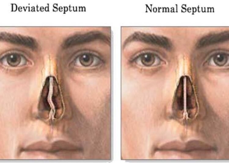 10yr old boy successfully undergoes Deviated Septum correction surgery