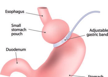 Reversible bariatric surgery performed on a 22-yr-old patient