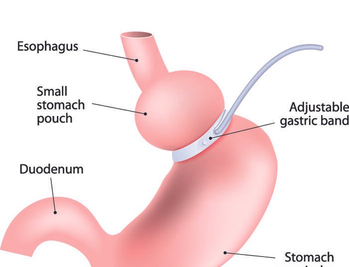 Reversible bariatric surgery performed on a 22-yr-old patient