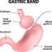 Reversible bariatric surgery performed on a 22-yr-old patient
