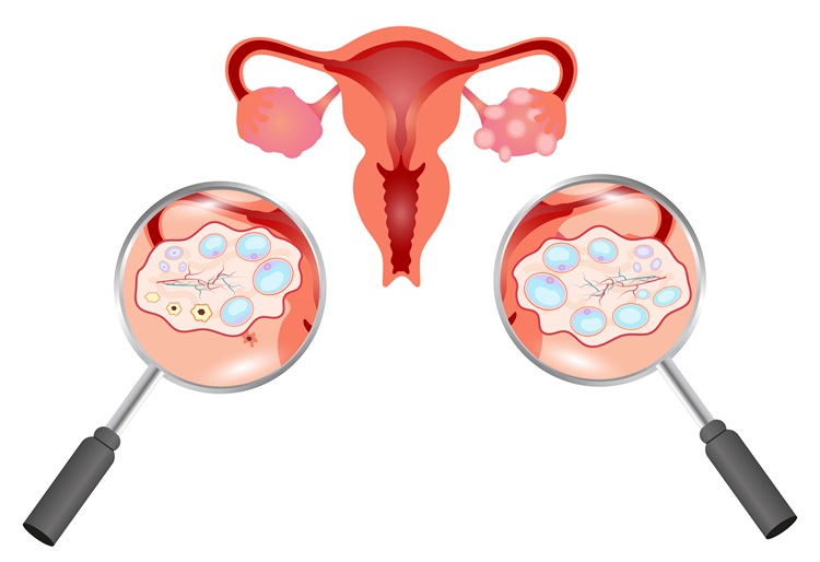 Ayurveda and Breathing Techniques May Help Manage PCOS
