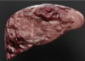 RAAS drugs may lower liver cancer risk in MASLD