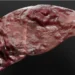 RAAS drugs may lower liver cancer risk in MASLD