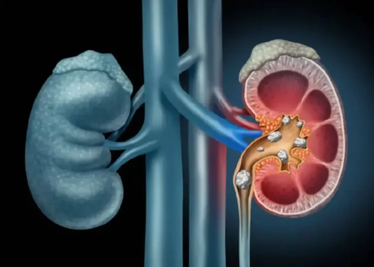 Water alone may not prevent kidney stones