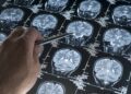 Blood tests may transform early alzheimer’s detection