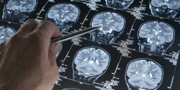 Blood tests may transform early alzheimer’s detection