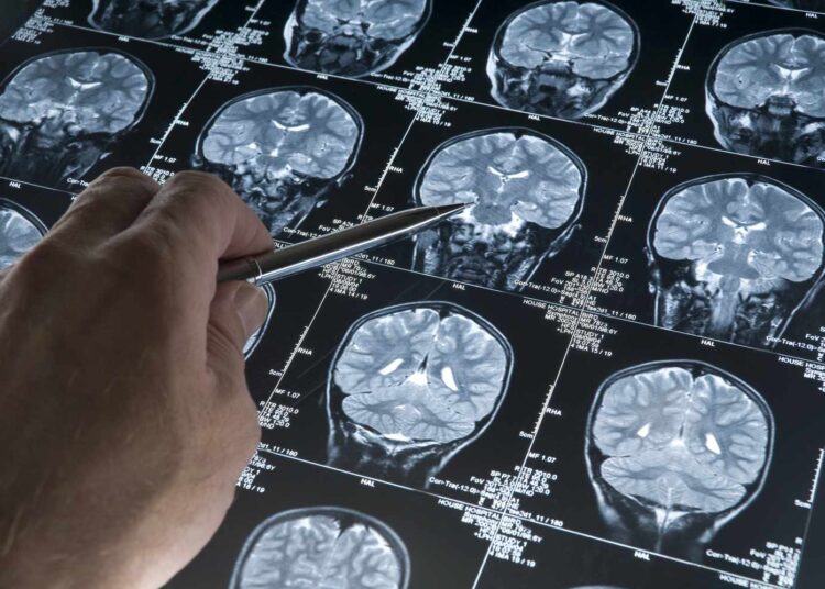 Blood tests may transform early alzheimer’s detection