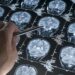 Blood tests may transform early alzheimer’s detection
