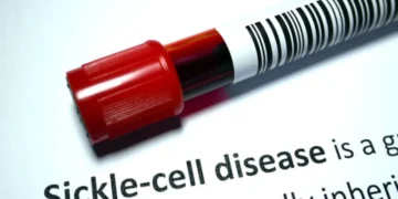 AIIMS Bhopal study urges early sickle cell screening