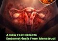 Menstrual Blood May Help Detect Endometriosis Early
