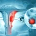 India Validates First Indigenous HPV Test for Screening