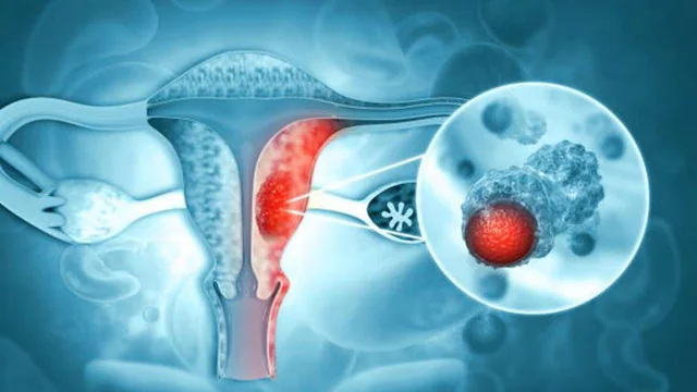 India Validates First Indigenous HPV Test for Screening