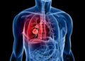 Blood Test May Predict Lung Cancer Five Years Early