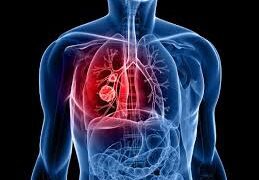 Blood Test May Predict Lung Cancer Five Years Early