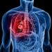 Blood Test May Predict Lung Cancer Five Years Early