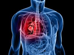 Blood Test May Predict Lung Cancer Five Years Early