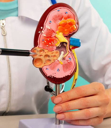 Silent Kidney Disease May Show No Early Symptoms