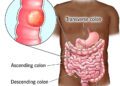 Study Reveals How Colon Cancer Spreads to the Liver