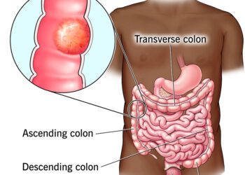 Study Reveals How Colon Cancer Spreads to the Liver