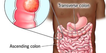Study Reveals How Colon Cancer Spreads to the Liver
