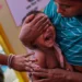 Measles Cases Rise in India, Jeopardising Elimination Goal