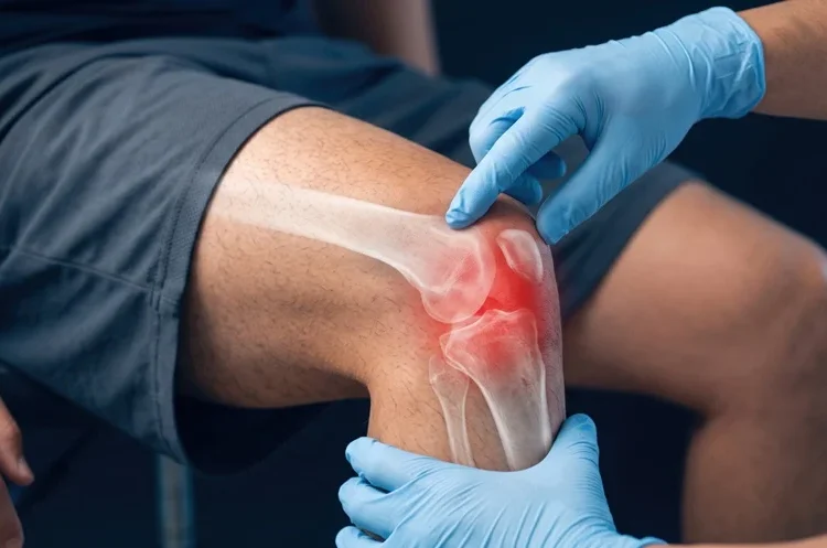 Early Arthritis Screening in the Netherlands Shows Lasting Benefits