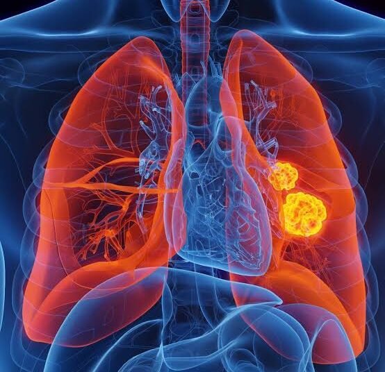 Why More Non-Smokers in India Are Developing Lung Cancer