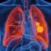 Why More Non-Smokers in India Are Developing Lung Cancer