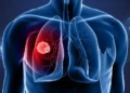 Why non-smokers are getting lung cancer