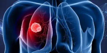 Why non-smokers are getting lung cancer