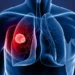 Why non-smokers are getting lung cancer