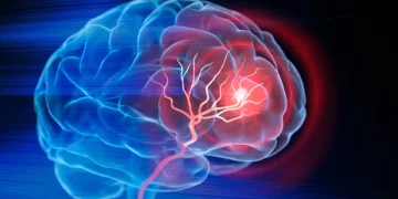 Ozempic may be linked to Lower Stroke and Alzheimer’s risk study finds