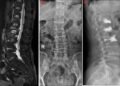 75-Year-Old woman with yearlong back pain Diagnosed with Osteoporotic Spine Fracture minimally Invasive spine surgery provides same-day relief