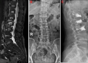 75-Year-Old woman with yearlong back pain Diagnosed with Osteoporotic Spine Fracture minimally Invasive spine surgery provides same-day relief
