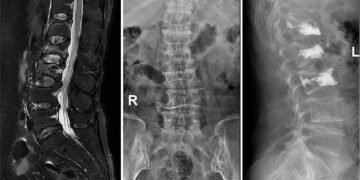 75-Year-Old woman with yearlong back pain Diagnosed with Osteoporotic Spine Fracture minimally Invasive spine surgery provides same-day relief