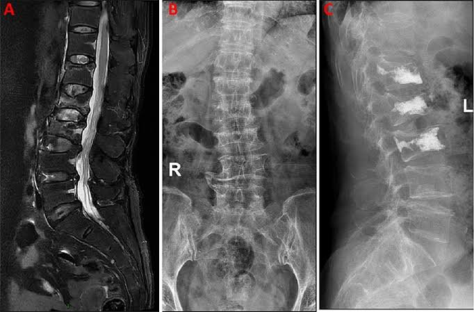 75-Year-Old woman with yearlong back pain Diagnosed with Osteoporotic Spine Fracture minimally Invasive spine surgery provides same-day relief