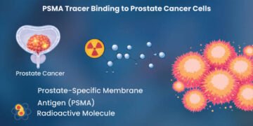 PSMA-PET guided Brachytherapy shows promise in recurrent Prostate Cancer