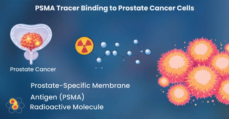 PSMA-PET guided Brachytherapy shows promise in recurrent Prostate Cancer