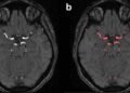 Integrated registry platform boosts heart and stroke research