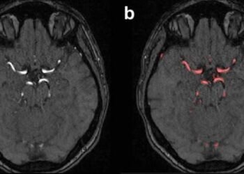 Integrated registry platform boosts heart and stroke research